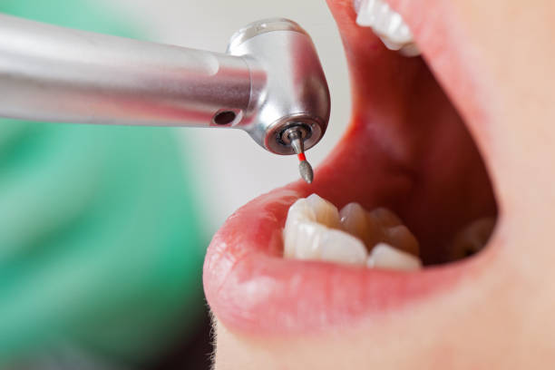 Best Emergency Tooth Extraction in Norwood, OK